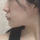 프라임의원 | 신사역피부과 에이브의원 프라임레이즈 리프팅레이저 솔직후기 효과