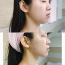 수원-0086 | 수원 영통 피부관리 포이에마피부샵에서 V_이중컷팅 조각술 받고 온 후기