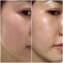 새울산약국 | 바노바기울산에서 리쥬란힐러 2cc 손주사 맞고 온 내돈내산 후기 / 통증, 효과, 주의사항