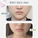 무지개투 | 뷰앤디 앤모드 프로 2주 사용 후기｜투턱 쓰리턱 변화 있음? 내돈내산 찐 후기 (사진 많음)