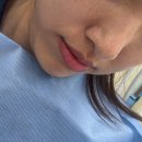 레드필 | 청담동 피부과에서 소프웨이브 온다 레드터치 프로 콜라움 하이포주사 후기 얼굴형 고민호소인 필 독