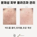 송도 남자 피부관리, 20대 남자 양볼 여드름과 흉터 피부관리 이미지