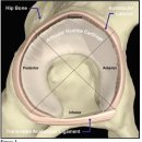 Acetabular Labral Tears 이미지