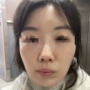 베니히룸 | [리뷰] 평촌 피부관리 '베니히룸' 플라즈마 모공관리 좋네