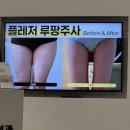 허벅지안쪽지방분해주사2회차 기록 플레저성형외과의원