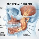경희생생한방병원 | 강서구 턱관절 한방치료 마우스피스와 침 병행 효과