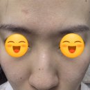 해피세탁전문점 | 대구플라즈마 반월당역에스테틱 추천 모공관리 콜드플라즈마 사마귀 제거 케어후기