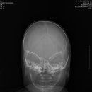 두개골조기유합증(시상봉합 진단) 이미지
