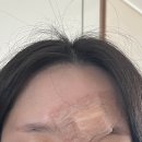 정바늘 | 대구 표피낭종 피지낭종 재발 피부과 재수술 후기 제거 비용