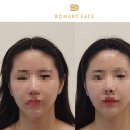 강남 안면비대칭관리 보나트페이스 후기