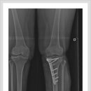 무릎인공관절시기를 늦춰라 -근위경골절골술에 대해 아시나요? 이미지