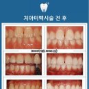 뽀드득치과 네이버블로그