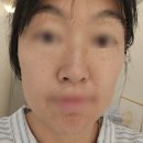 피부하우스 | 첨단 피부관리 로라 뷰티 하우스에서 홍조 관리받은 후기