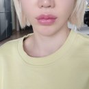 대전물차 | 대전 올타이트리프팅 처진 하관 심부볼 전후비교 키닥터 솔직후기