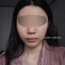 (주)이사플러스 | 메디큐브 하이포커스샷 프로 플러스 내돈내산 한달 효과 전후 땅콩형 후기 볼패임 부작용