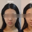 차한의원 | 안면비대칭 잡아주는 한의원 10회차 후기