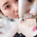 ㈜휴엔리메디칼 | 마리꼬 저자극 필링 더모필링 솔직 후기/ 더모PH - 더마 브래이젼/ 에스테틱 필링 관리 후기/ 각질 관리