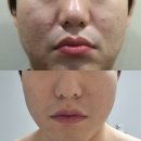 약초 | 상동역 여드름 피부과 흉터관리 약초필링 재생관리 후기