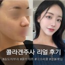 눈밑 꺼짐 다크써클 땅콩형 얼굴 볼패임 피부시술 추천 [콜라레쥬] 송도피부과 리얼 후기