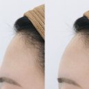 6958 | 강남 이마주름필러, 후기보고 똑같이 해달라고 하면 실패합니다