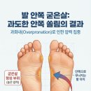 굳은살