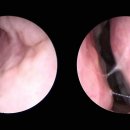 (주)코숨 | 코 막혀 숨 안 쉬어지면 공황장애까지? 50대 남성 수술 후기