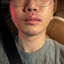 김해-장유-1-비상-1 | 김해장유 남자얼굴레이저 제모추천 1회차 후기