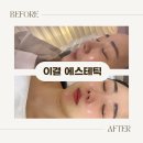 88 | 만수동피부관리 이결에스테틱, 만수동문제성피부관리로 홍조 고민 해결!