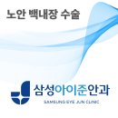 부산 삼성아이준안과가 알려주는 백내장 상담에서 자주 언급되는 5가지 질문