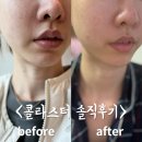 멍스터 | 용산역피부과 MTS 시술 콜라겐스킨부스터 콜라스터효과 멍,붓기,통증 모공축소 종류,부작용 후기~