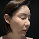 대우땅콩 | 청담 압구정로데오역 피부과 엘란쎄 필러 얼굴형 보정 추천 효과 후기