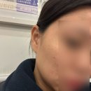 민클리닉의원 | 피부과 후기 | 마곡 빈센트의원 턱 보톡스 내돈내산 후기