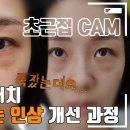 [4K] 셀카 찍을 때 다크 신경쓰이시는 분들! 다크 개선과정 수술부터 붓기, 개선 과정까지! 이미지