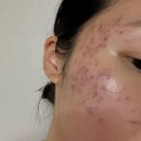 로담한의원 | 여드름흉터치료 로담한의원 새살침 후기