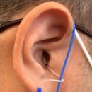 이화보청기 이미지