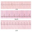 서맥[Bradycardia]순환기질환 이미지