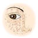 주근깨[Freckle,Ephelis]피부질환 이미지