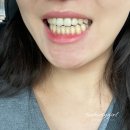 명품치과기공소 | 강남 무삭제 라미네이트 결정했어요!! (신사역치과 라미네이트 후기)