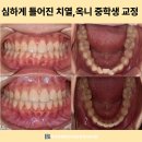 연세바로치과교정과치과의원 | 부천 내동 치과 심하게 틀어진 치열, 옥니 중학생 교정 (교정장치 후 양치질의 중요성)