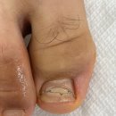 레푸스인하대역점 내성발톱 무좀발톱 발각질 문제성발 이미지