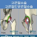 고관절 인공관절수술후 관리 이미지