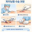 강병준 | 🔥 엉덩이 피지낭종 수술 후기, 생각보다 아픈가요?
