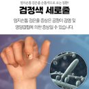 엄지손톱검은세로줄 흑색종 손톱에 가로줄 뭘까? 이미지