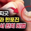 무좀 없애는 법, 한포진 치료 방법 깨끗한 발을 만드는 가장 쉬운 방법 이미지