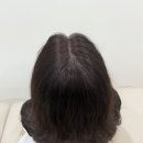 이제이헤어 - 동구 | [이제이 두피&데콜테] 정수리 두피문신(SMP) 시술 후기