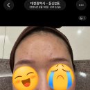 제생약국 | 결혼식전 염증주사로 패인 얼굴, 흉터 회복 후기 대장정, 여드름 흉터 좋아진후기 공유 내돈내산