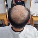 모자티헤어증모 | 연산동 남자가발 맞춤 제작 후기! 밀착감, 자연스러움 다 잡은 모이든 증모가발 연산점