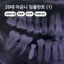 SP-5A06 | 20대 어금니 임플란트 내돈내산 1편 | 치과기준, 가격, 종류(오스템 vs 스트라우만) 뼈이식