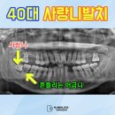 중원 | 40대 사랑니발치 후기, 성남 중원구 사랑니 전문의 병원