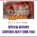양악수술 받을 때 반드시 교정 치료 받아야 할까? ( 기능목적 미용목적 모두 해당 )